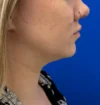 Neck Liposuction case #16426