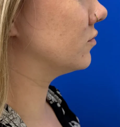Neck Liposuction case #16426
