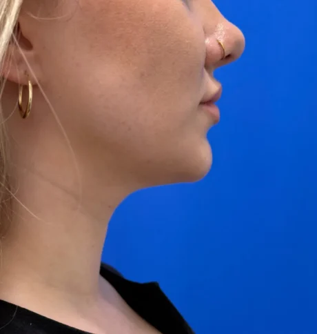 Neck Liposuction case #16426