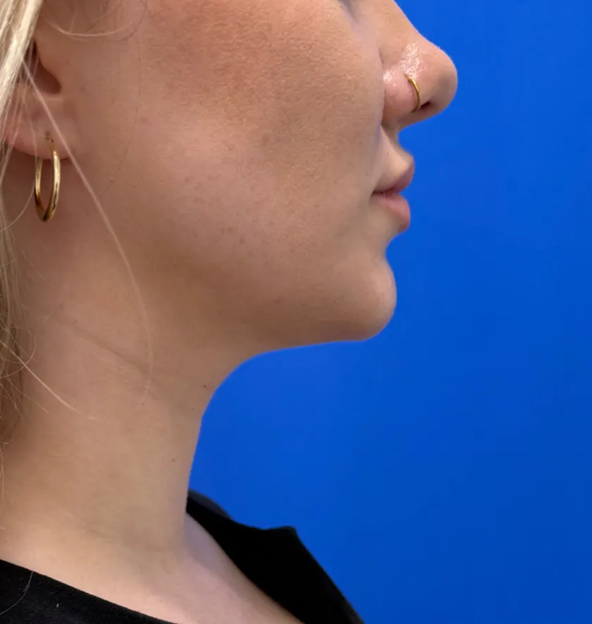 Neck Liposuction case #16426