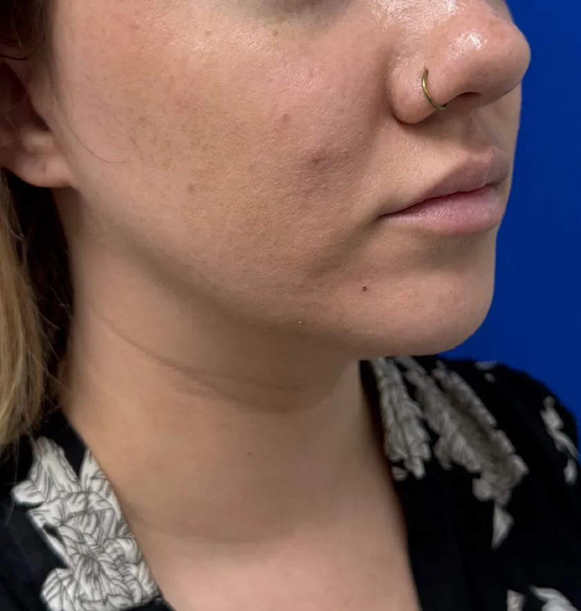 Neck Liposuction case #16426