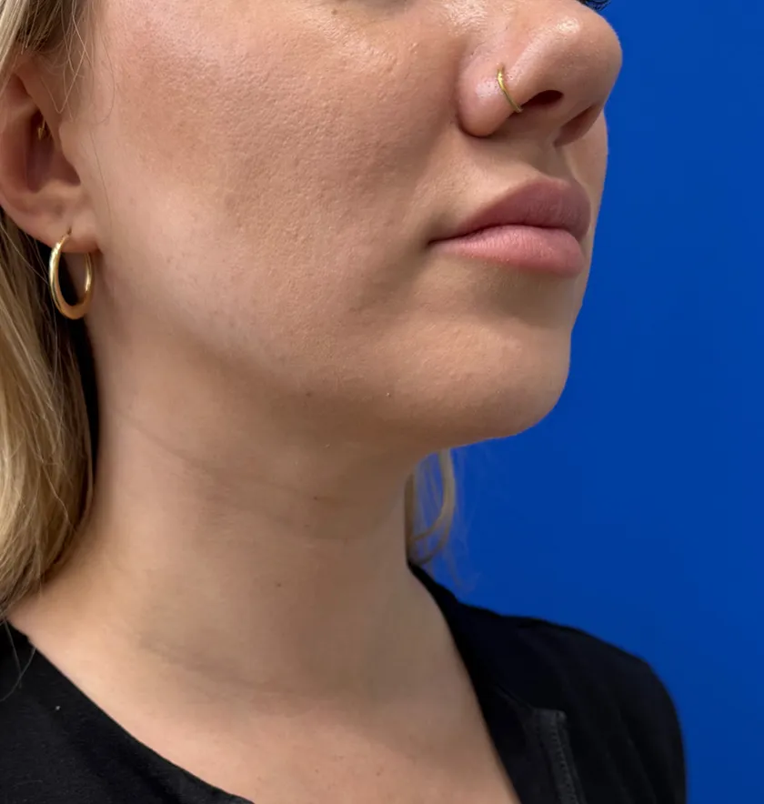 Neck Liposuction case #16426