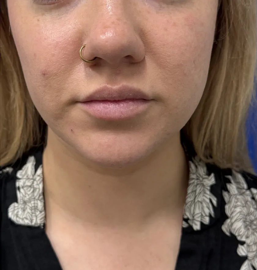 Neck Liposuction case #16426