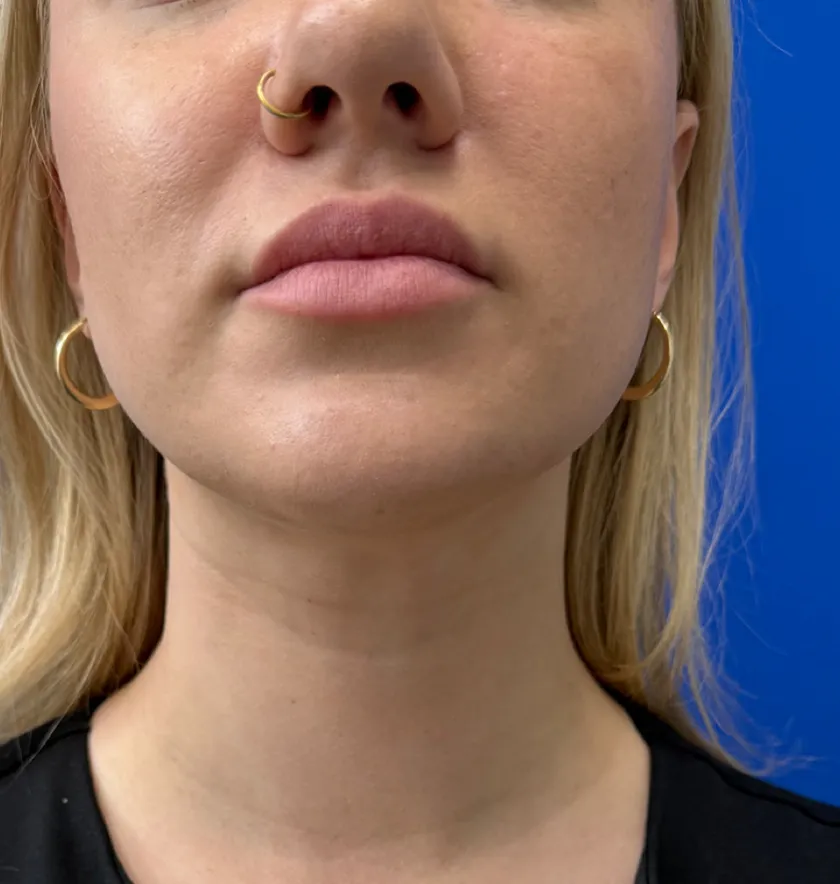 Neck Liposuction case #16426