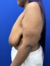 Breast Reduction case #16830