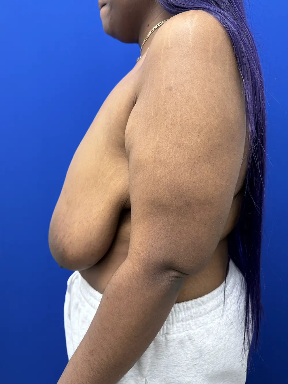 Breast Reduction case #16830