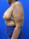 Breast Reduction case #16830