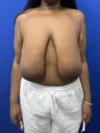 Breast Reduction case #16830