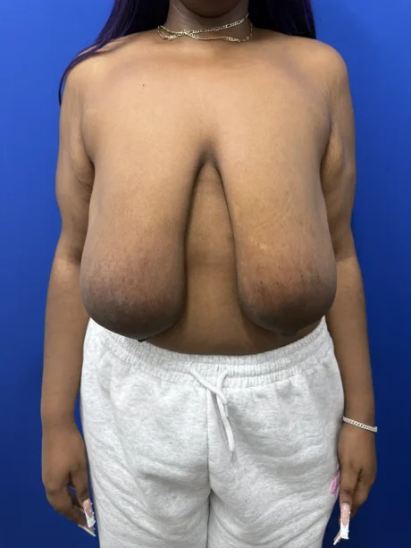 Breast Reduction case #16830