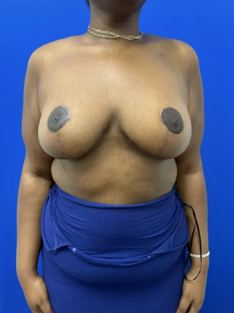 Breast Reduction case #16830