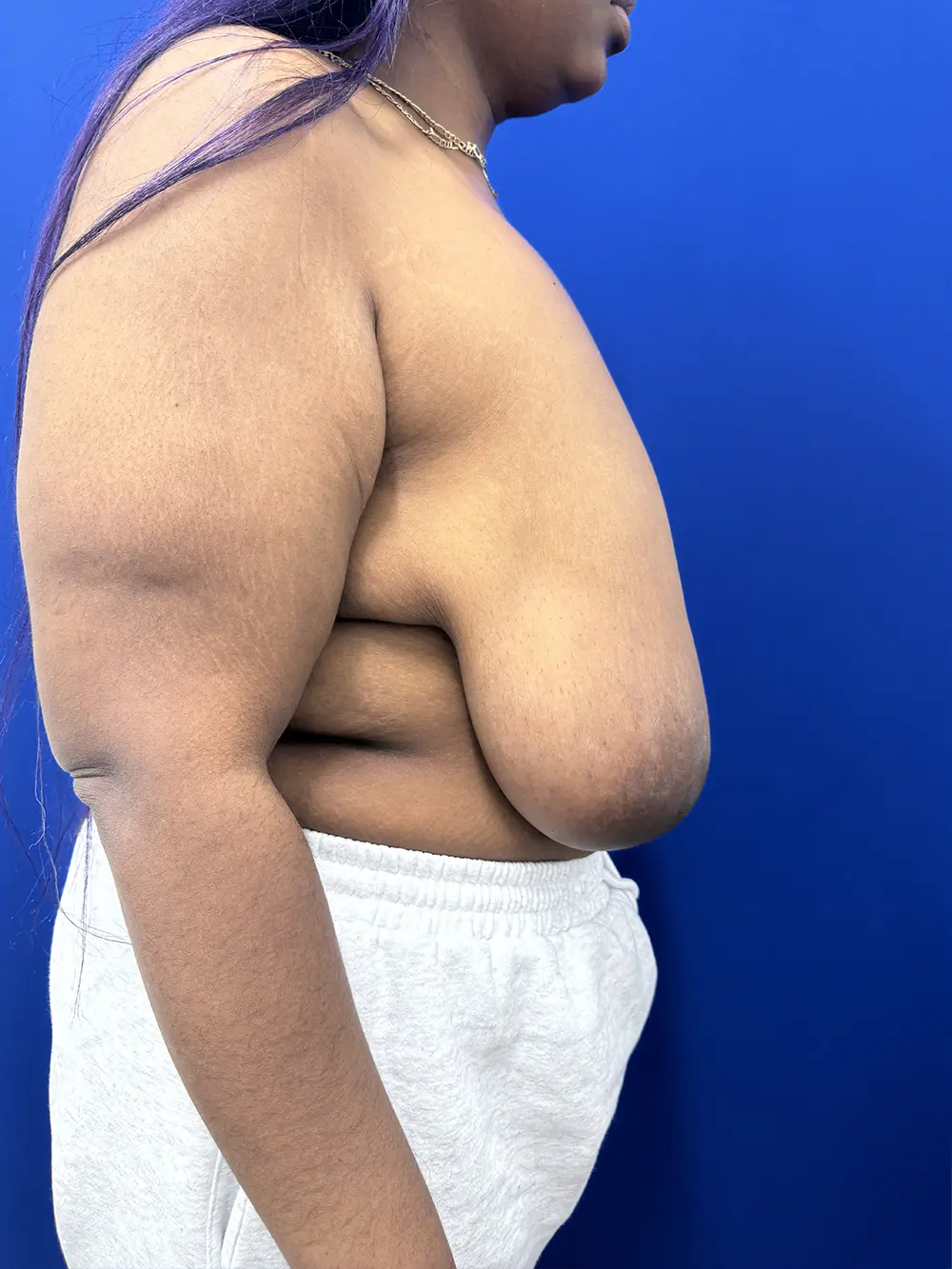 Breast Reduction case #16830