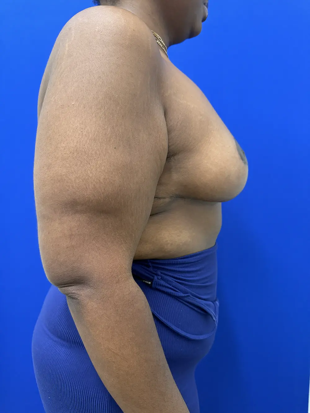 Breast Reduction case #16830
