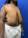 Breast Reduction case #16830