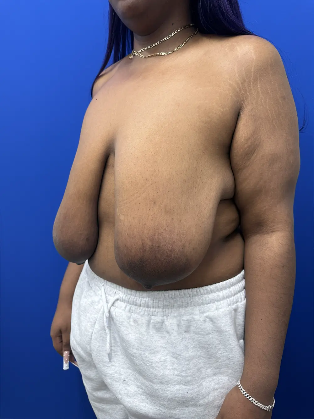 Breast Reduction case #16830