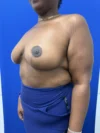 Breast Reduction case #16830