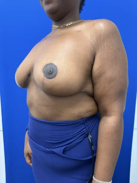 Breast Reduction case #16830