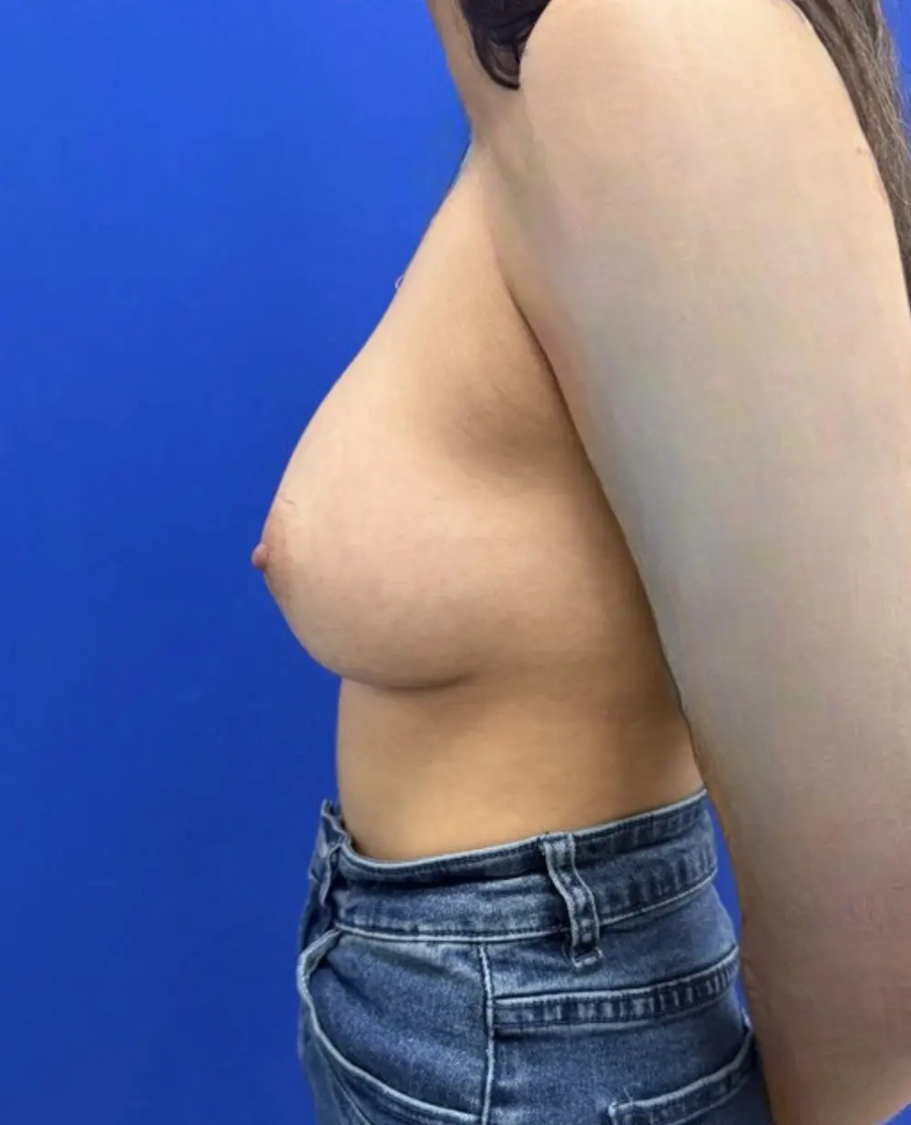 Motiva Preservé Breast Augmentation case #16816