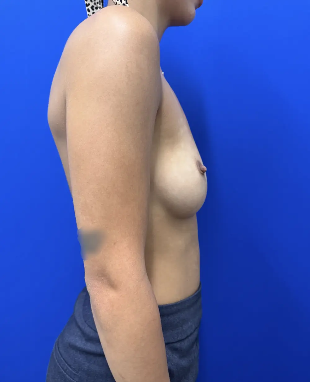 Motiva Preservé Breast Augmentation case #16865