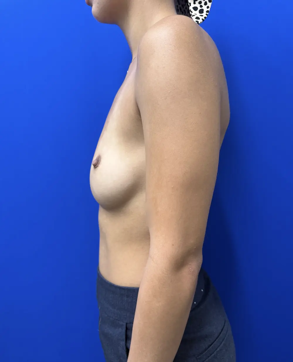 Motiva Preservé Breast Augmentation case #16865