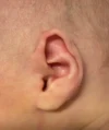EarWell System case #17149