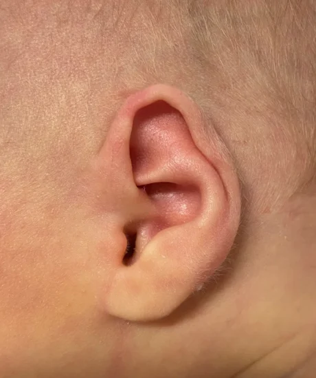 EarWell System case #17149