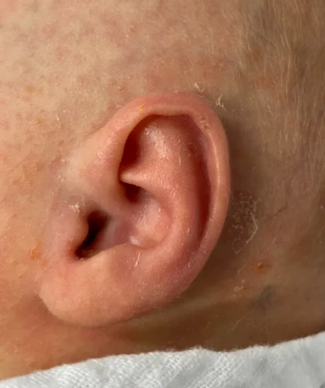 EarWell System case #17149