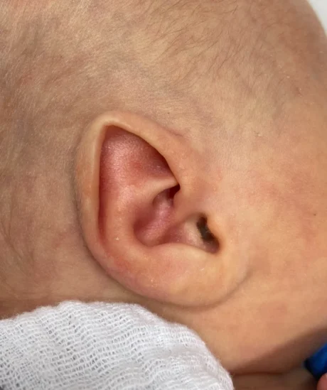 EarWell System case #17149