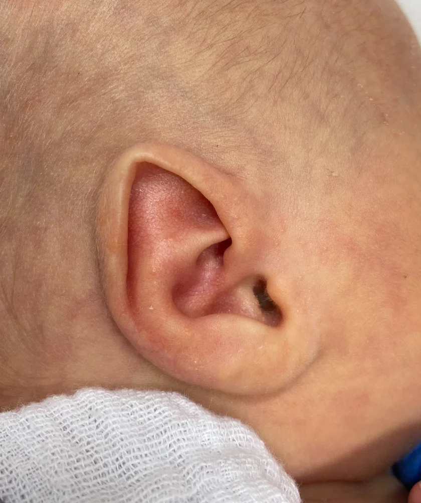 EarWell System case #17149