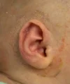 EarWell System case #17149