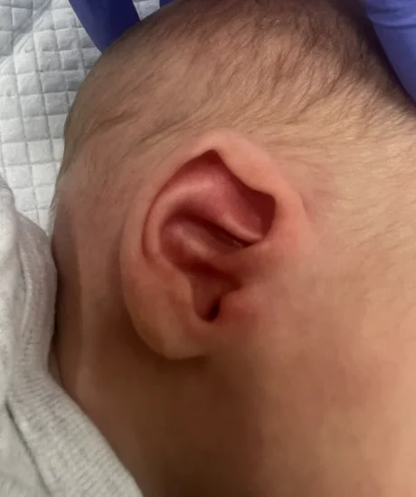 EarWell System case #17158