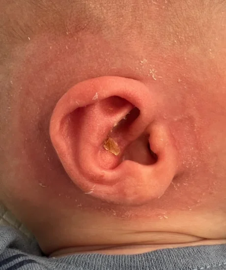 EarWell System case #17158