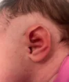 EarWell System case #17150