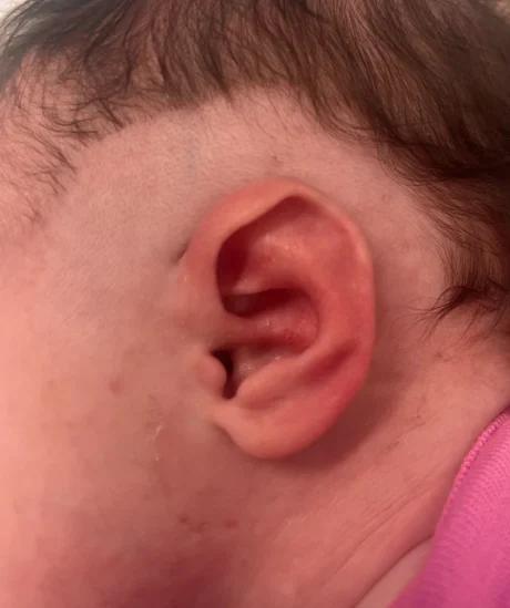 EarWell System case #17150