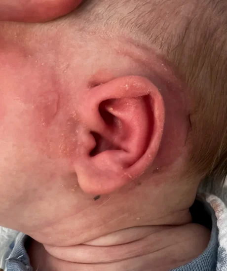 EarWell System case #17151