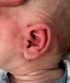 EarWell System case #17151