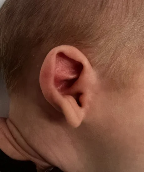 EarWell System case #17151