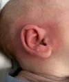 EarWell System case #17151