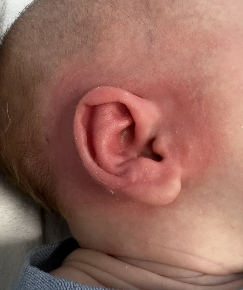 EarWell System case #17151