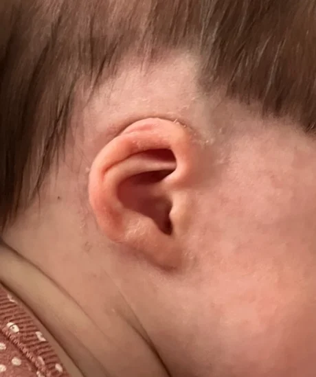 EarWell System case #17152