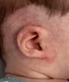 EarWell System case #17152