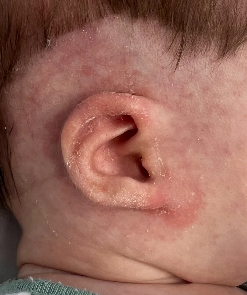 EarWell System case #17152
