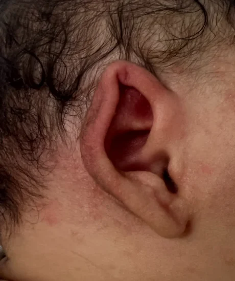 EarWell System case #17153