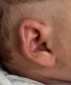 EarWell System case #17153