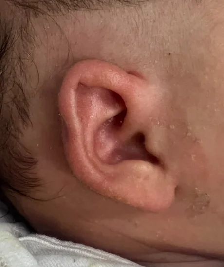 EarWell System case #17153