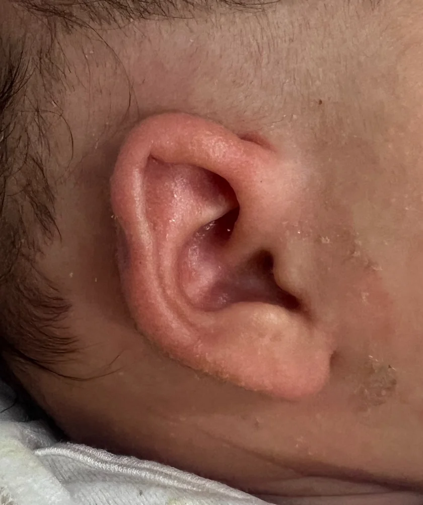 EarWell System case #17153