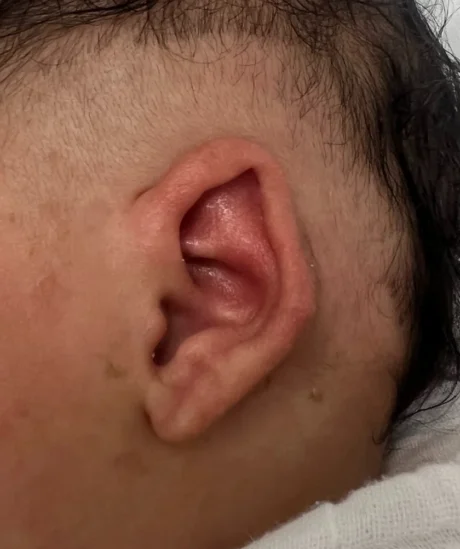 EarWell System case #17153