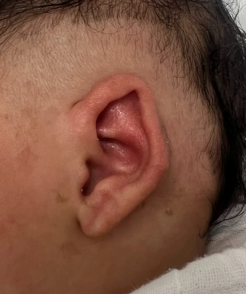 EarWell System case #17153