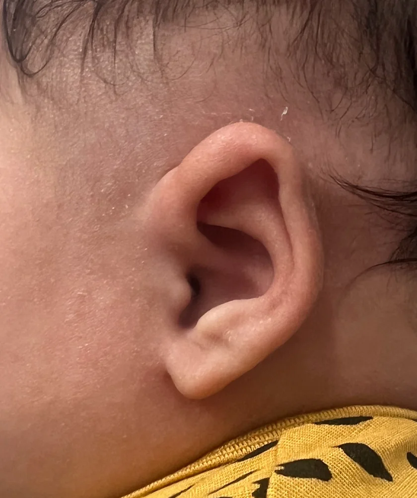 EarWell System case #17153
