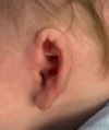 EarWell System case #17154
