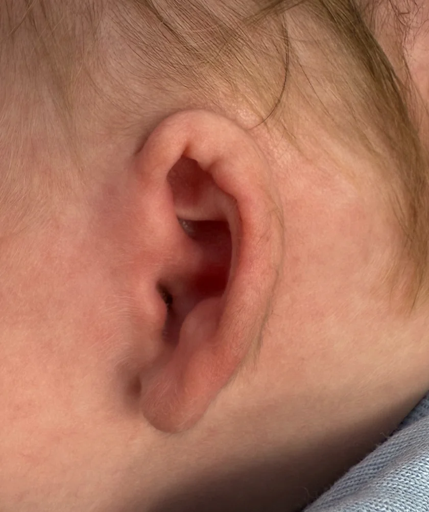 EarWell System case #17154